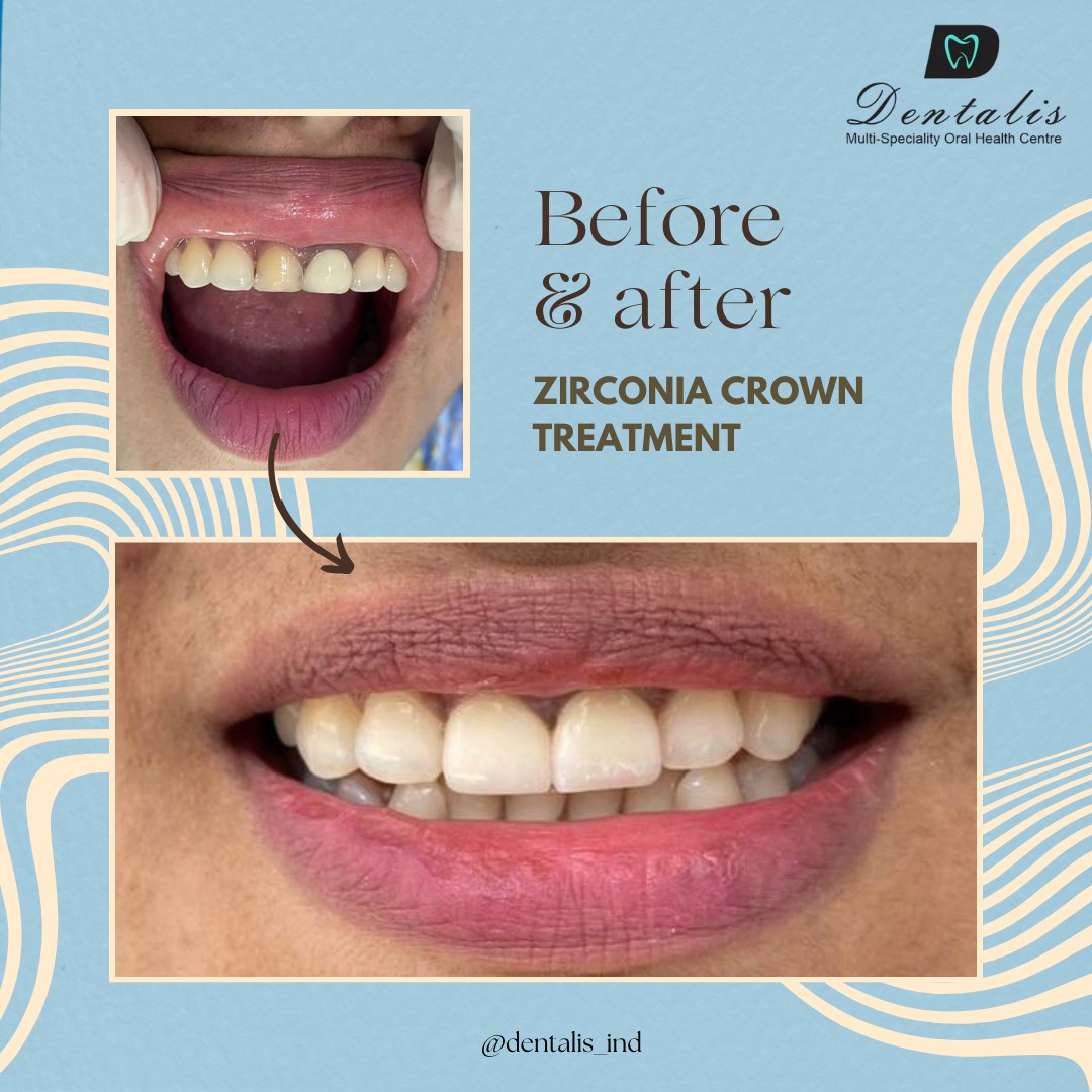 Why Zirconia Crowns Are the Future of Dental Restoration
