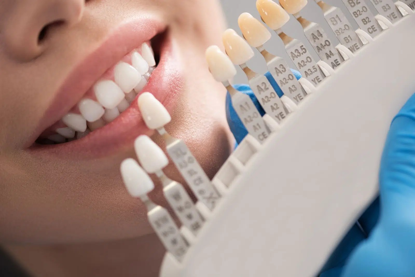 Beyond the Bite: How Dental Crowns in Whitefield, Bangalore Can Truly Protect Your Teeth
