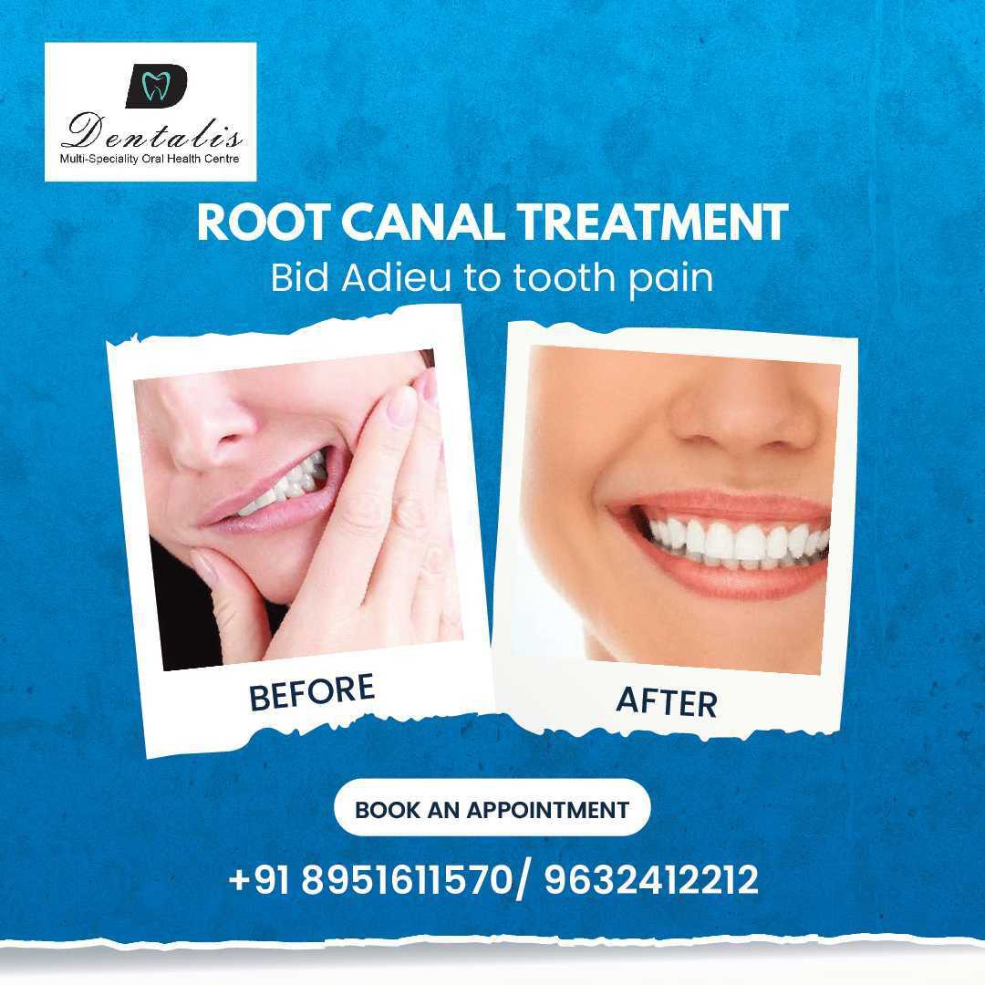 Root Canal Treatment in Whitefield | root canal treatment near me