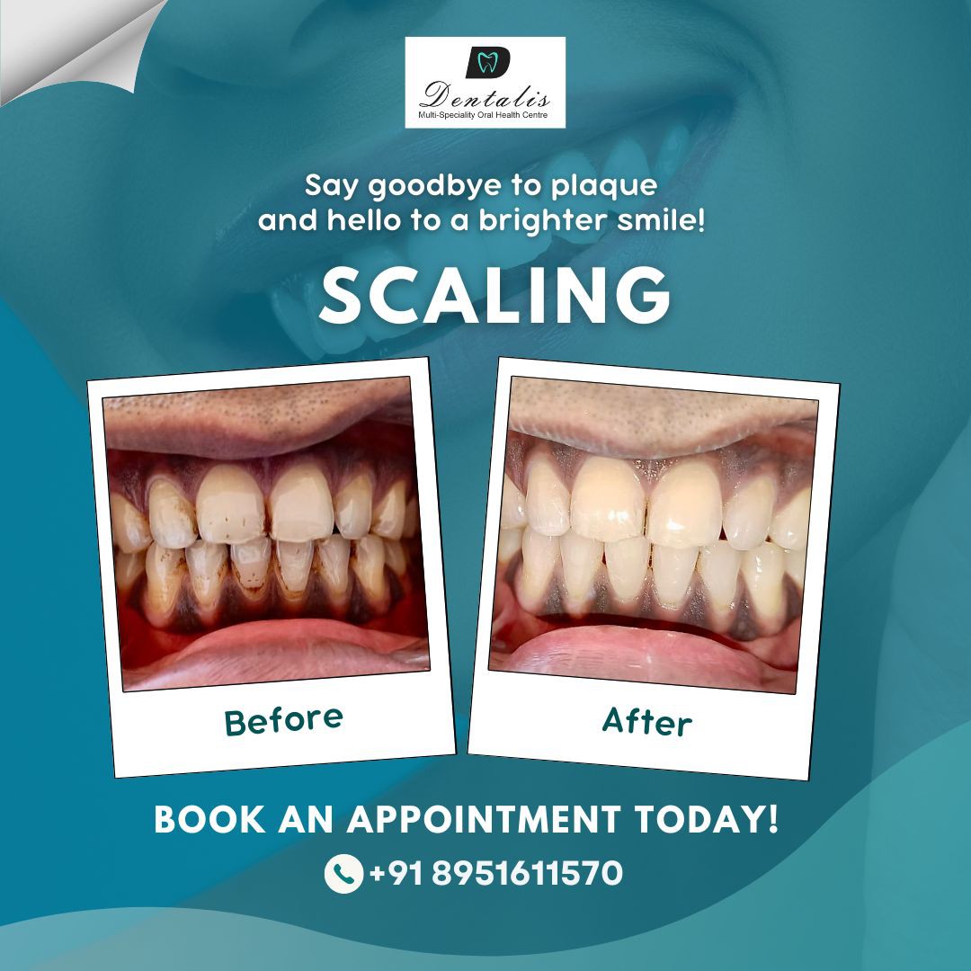 Experience the Best Scaling and Polishing in Whitefield, Bangalore at Dentalis