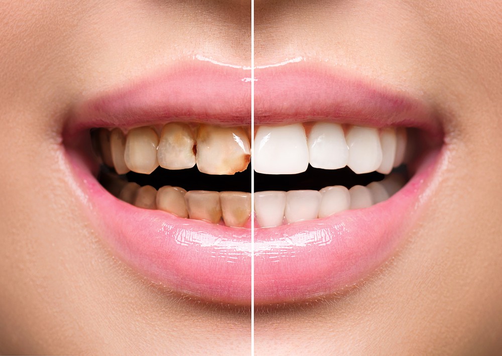 Transform Your Smile: Cosmetic Dentistry in Whitefield, Bangalore