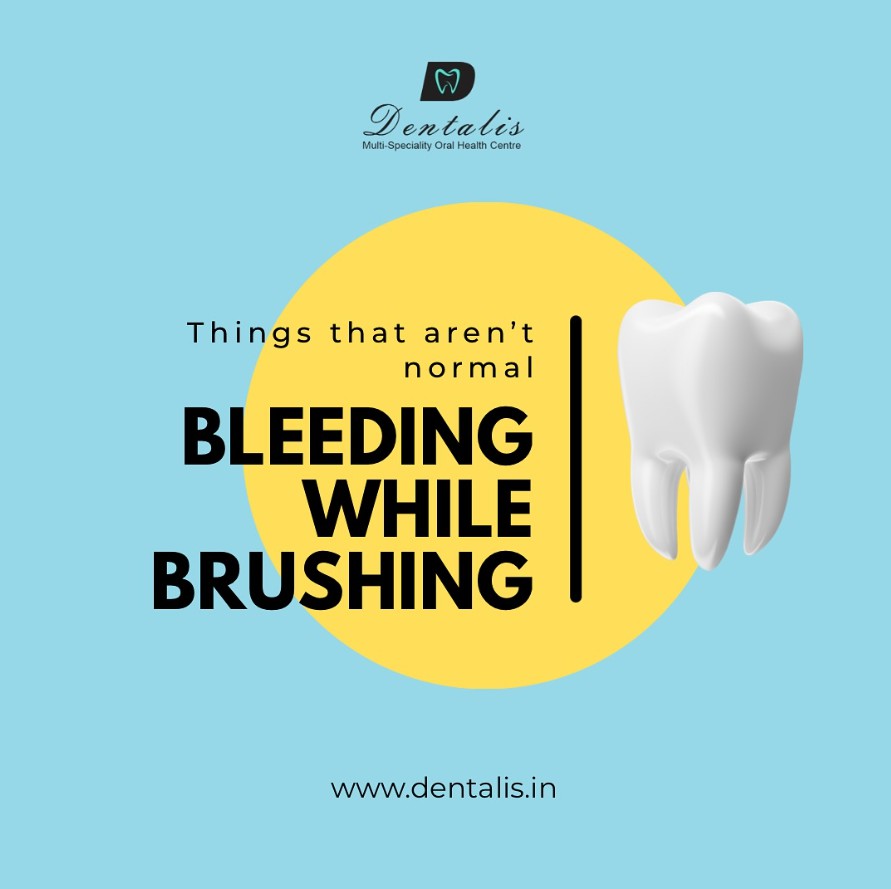 Bleeding Gums in Whitefield? Don't Ignore It! Understanding and Treating Periodontal Disease