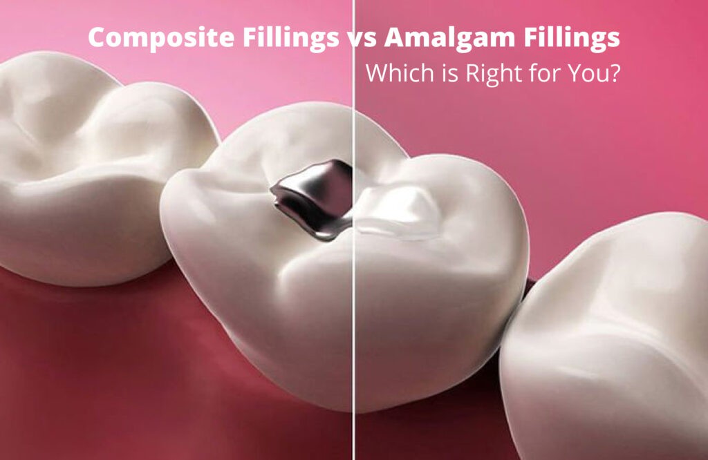Composite vs. Amalgam: Choosing the Right Filling for Your Smile in Whitefield, Bangalore