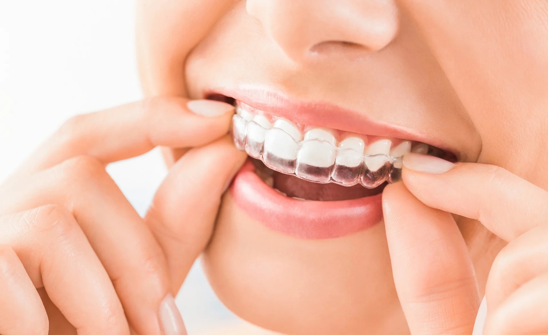 Beyond Straight Teeth: The Unexpected Benefits of Invisalign Aligners You Didn't Know