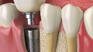 From Missing Tooth to Confident Smile: Real Stories of Affordable Dental Implants in Whitefield, Bangalore