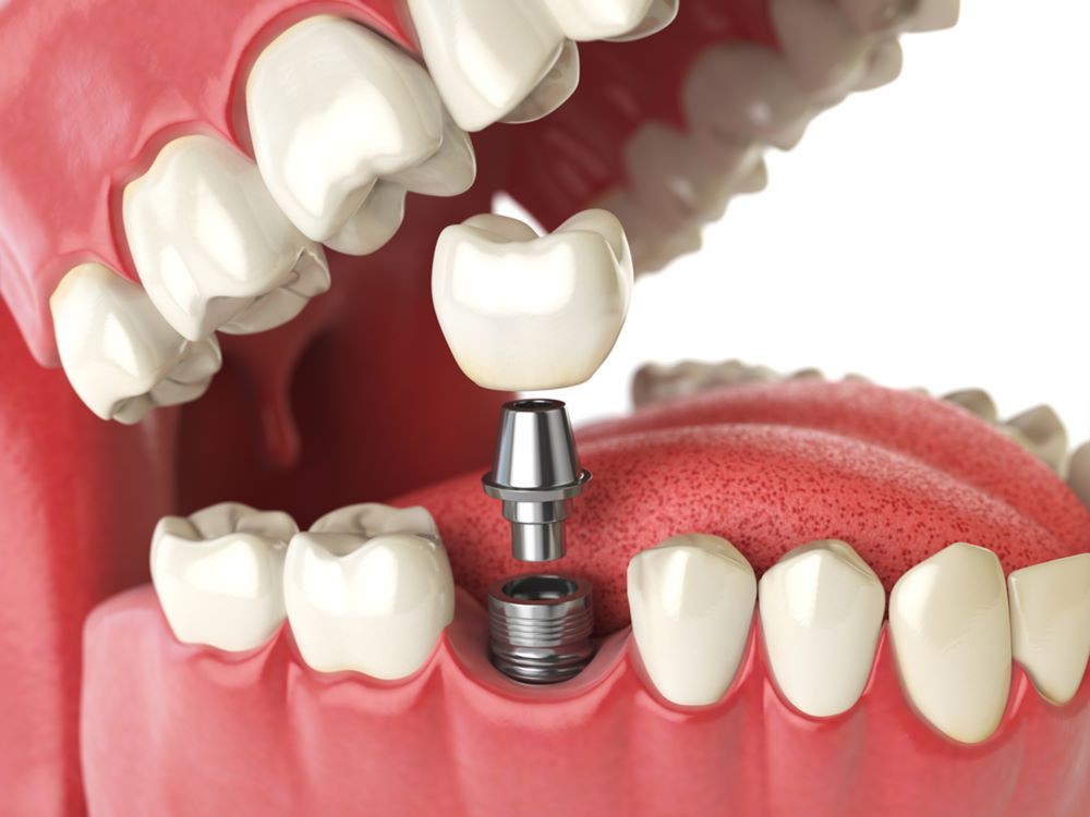 Real Patient Stories: Affordable Dental Implant Success Stories in Whitefield, Bangalore