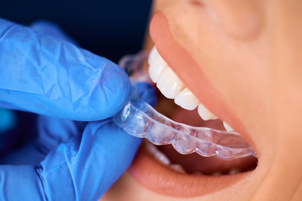 Invisalign Aligners in Whitefield, Bangalore | Dental Clinic for Aligners