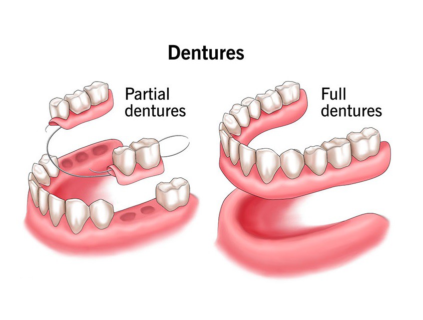 Goodbye Gaps, Hello Confidence: Your Guide to Dentures in Whitefield, Bangalore