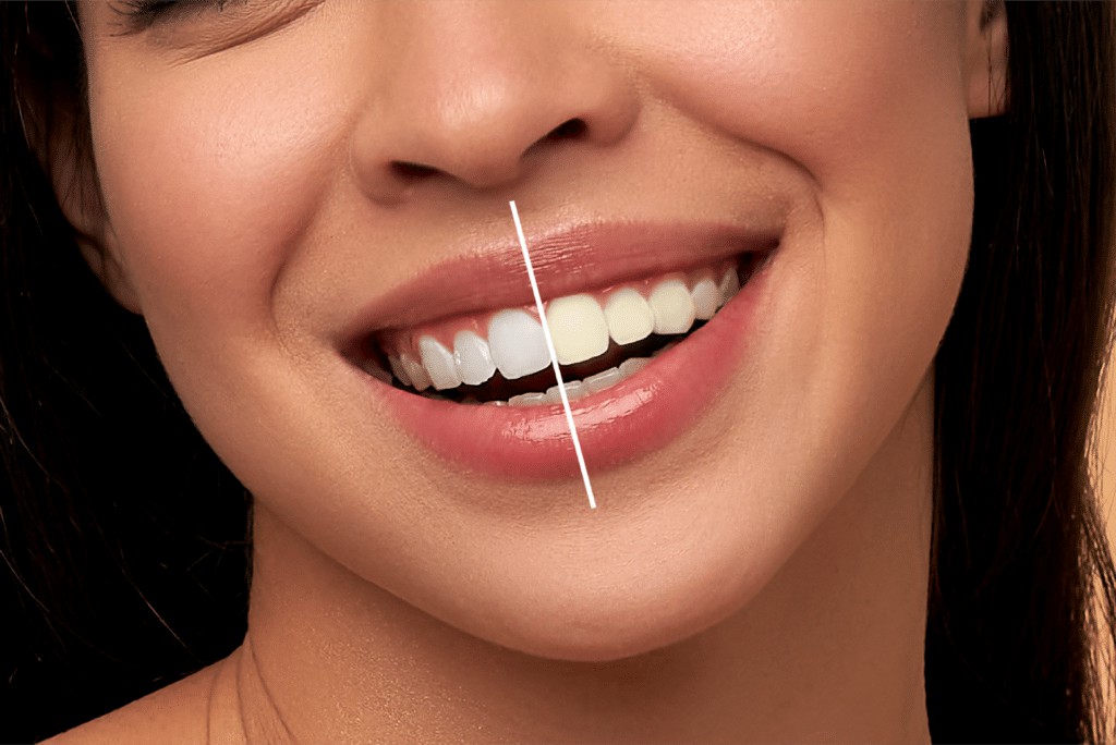 Teeth Whitening in Whitefield, Bangalore | Teeth Whitening Near Me