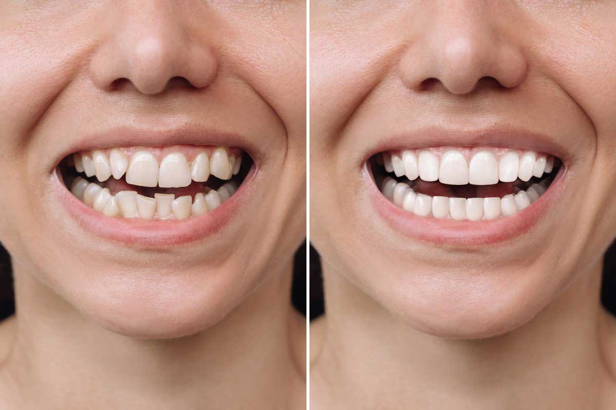Invisalign Transformation: Real Stories from Whitefield Patients & What to Expect