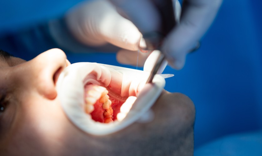 Pain-Free Fillings: What to Expect During Your Dental Filling Procedure in Whitefield