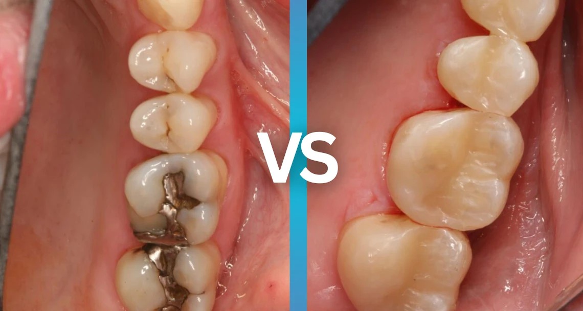 Advanced Dental Fillings in Whitefield, Bangalore: Beyond Traditional Amalgam