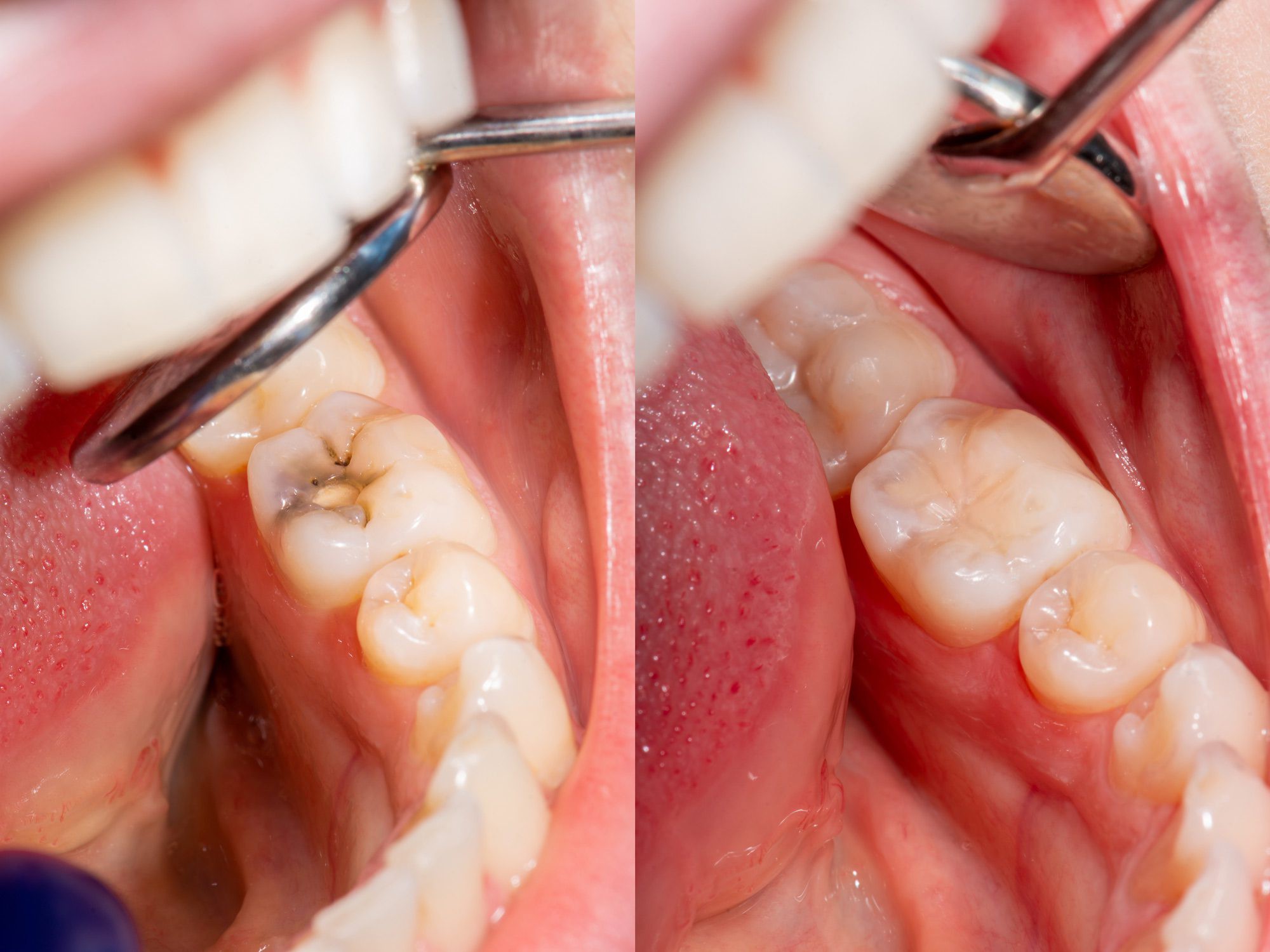 Beyond Silver: Choosing the Right Dental Filling Material for Your Smile in Whitefield, Bangalore