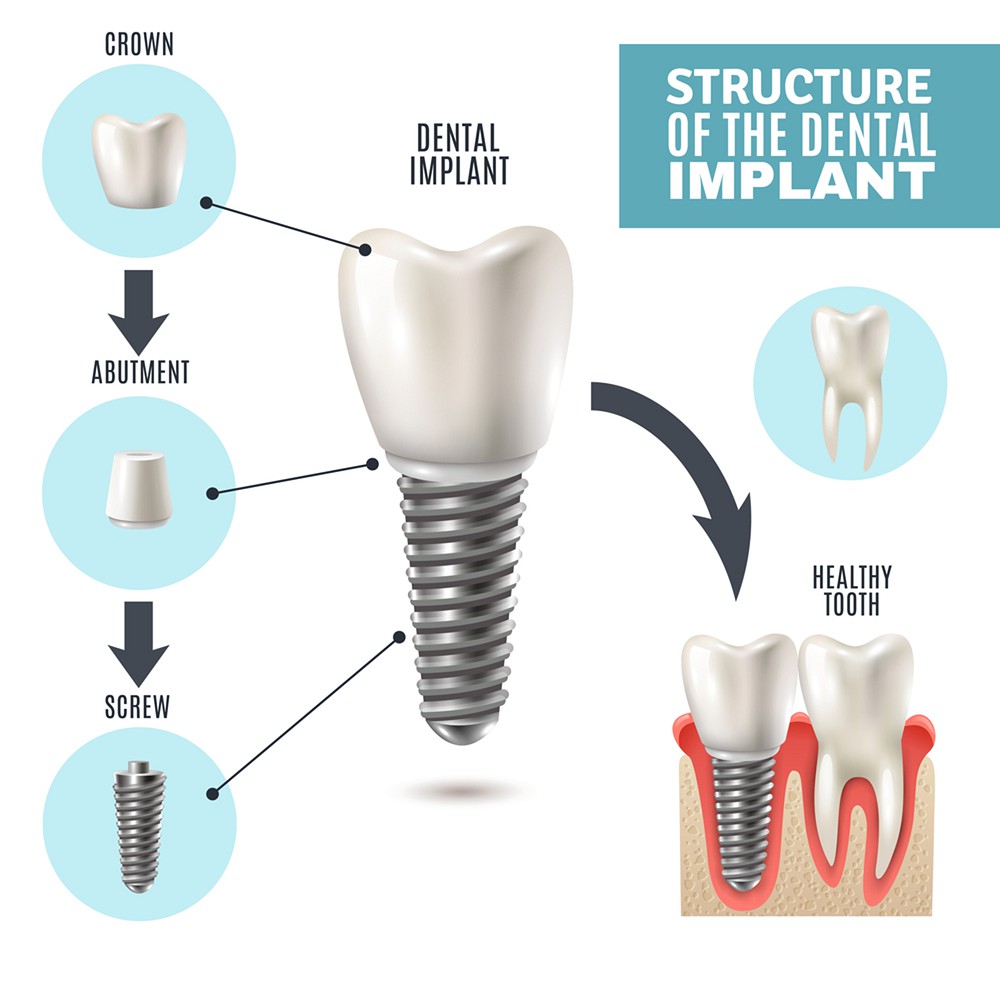 The Ultimate Guide to Finding Affordable Dental Implants in Whitefield, Bangalore: Questions to Ask and Red Flags to Watch Out For
