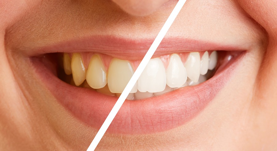 Achieve a Sparkling Smile: Best Scaling and Polishing in Whitefield, Bangalore
