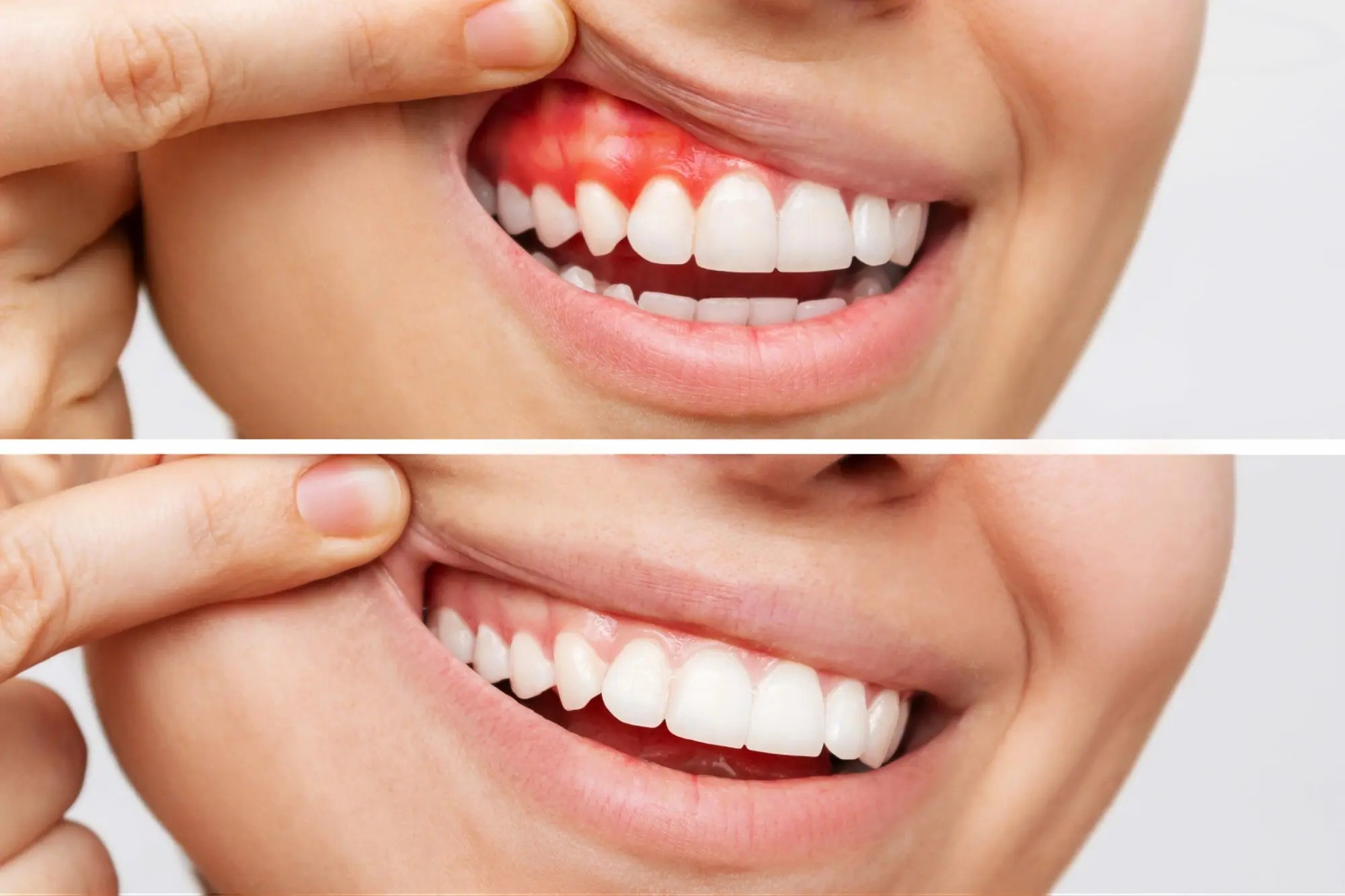 Periodontology in Whitefield, Bangalore: Non-Surgical Gum Disease Treatment Options