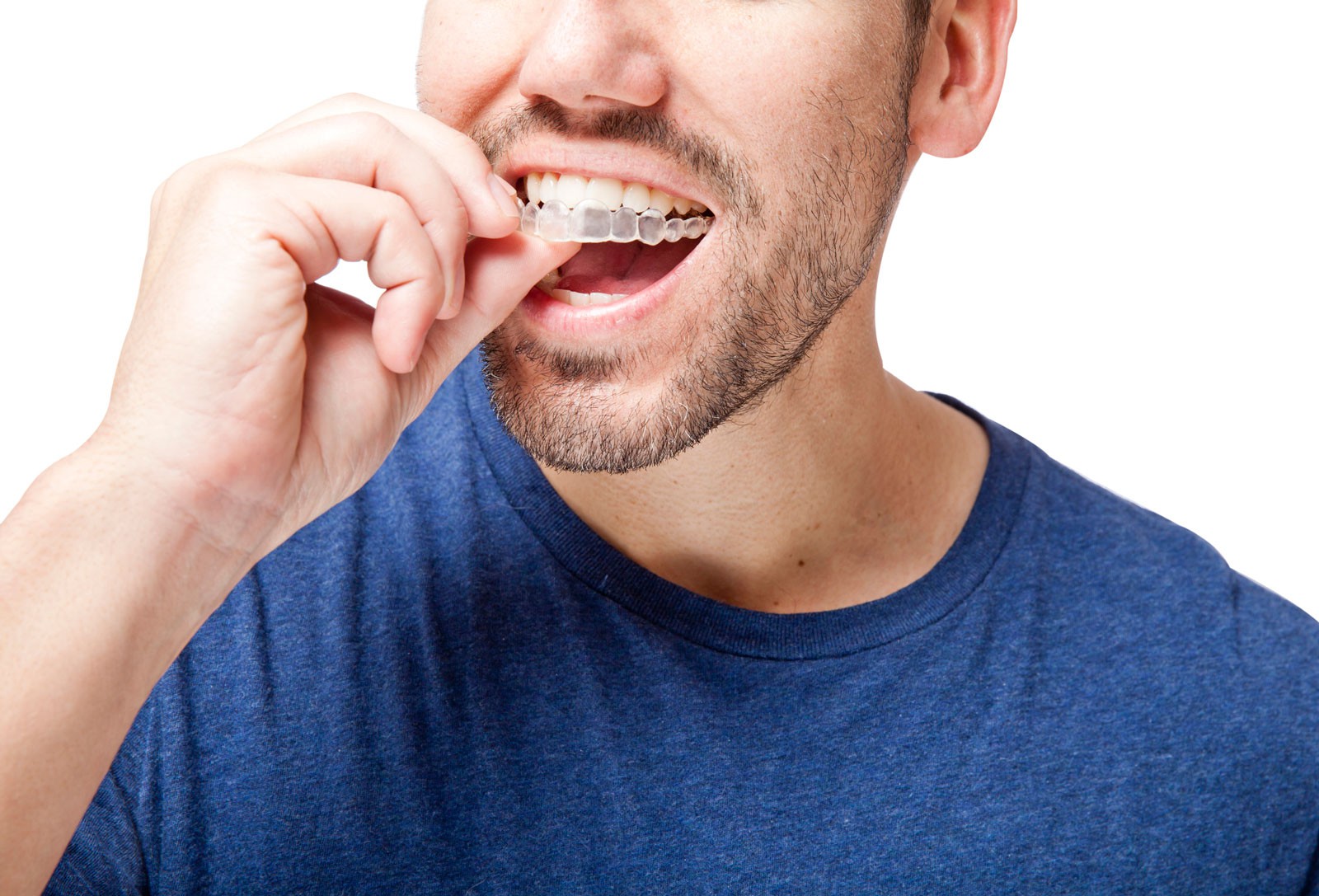 Top 5 Questions About Invisalign Aligners Answered by a Whitefield Dentist
