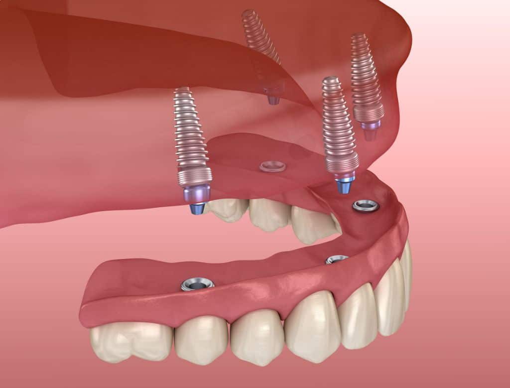 Dentures in Whitefield, Bangalore: Your Guide to Modern Options