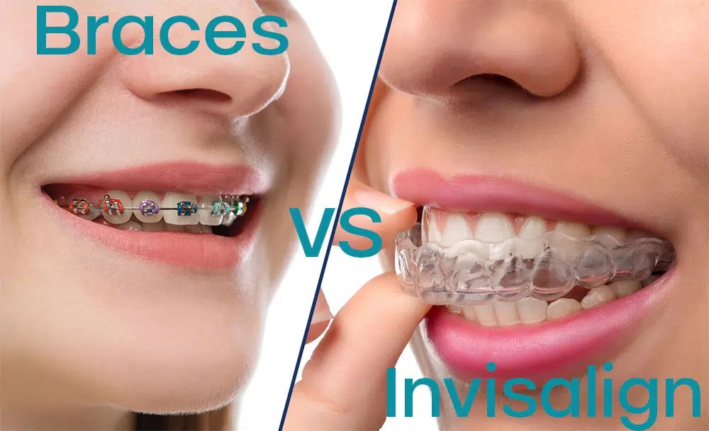 Invisalign vs. Braces: Which Smile Straightening Option is Right for You?