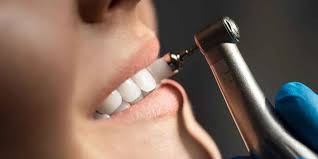 Is Scaling & Polishing Right for You? Debunking Myths and Revealing the Truth About Professional Teeth Cleaning