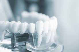 Beyond the Price Tag: What to Ask Your Dentist Before Getting Affordable Dental Implants