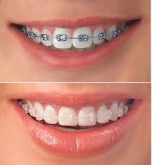 Best Orthodontics in Whitefield, Bangalore: Experience the Future of Straight Teeth