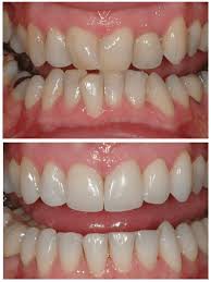 Fix Gaps and Crooked Teeth Without Braces